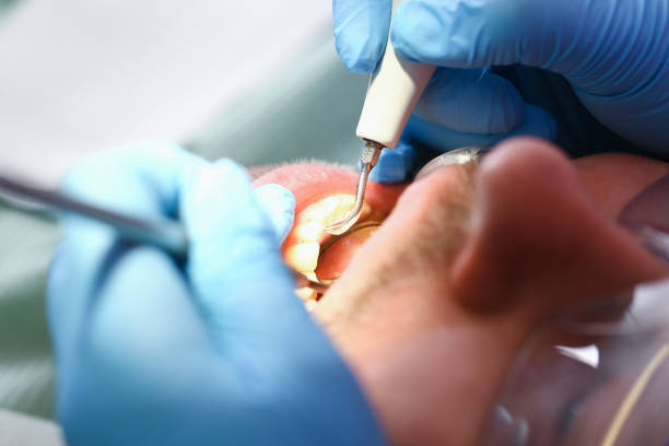 Best Emergency Dental Care for Abscessed Tooth in Keystone, FL